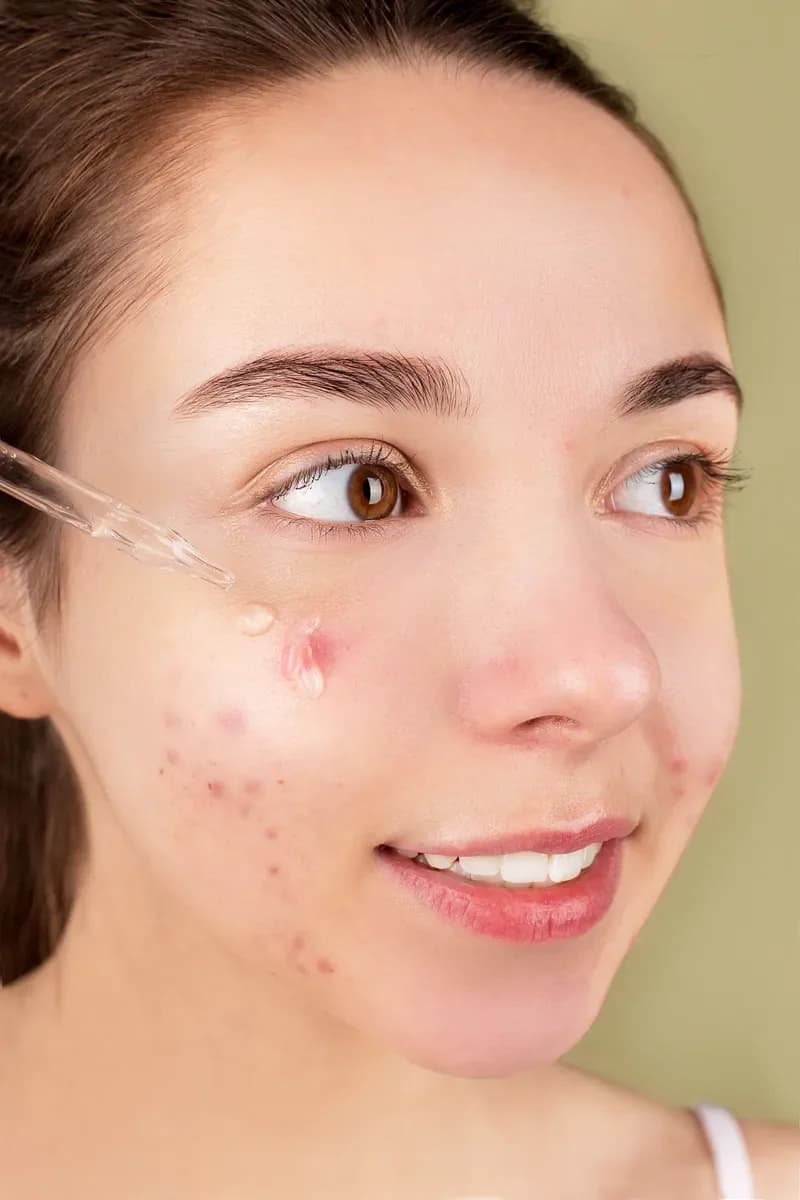 Young woman with dark hair and red blemishes on her cheek, looking to the side